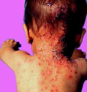 儿童银屑病的流行病学和临床特征有什么