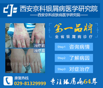 郑州哪儿看牛皮癣好 郑州哪儿看牛皮癣好