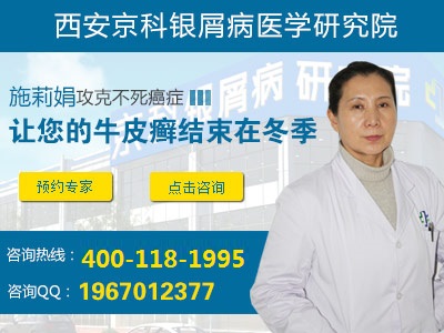 郑州牛皮癣医院